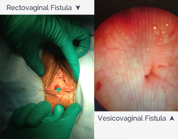 Genitourinary And Rectovaginal Fistula Star Clinic 